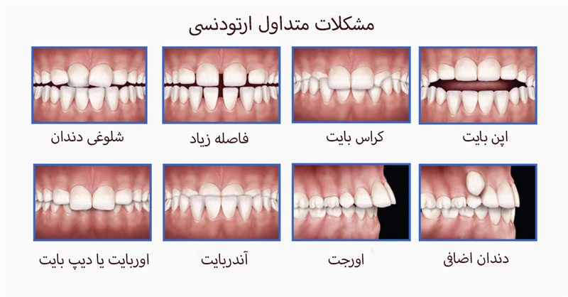 مشکلات متداول ارتودنسی